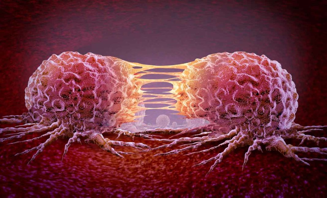Cáncer metastásico: Pacientes pueden recibir nuevos tratamientos para retardar progresión del cáncer