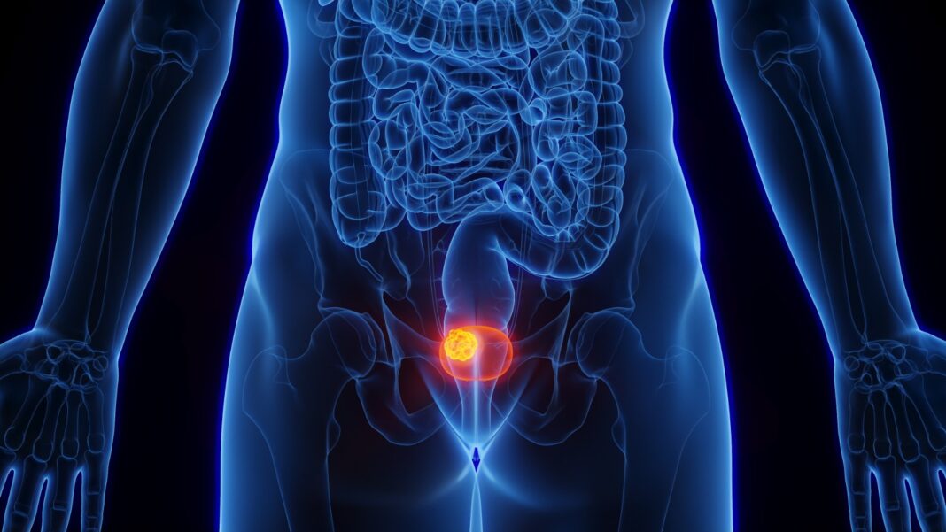 IMFINZI® de AstraZeneca reduce riesgo de recaída y mejora supervivencia en pacientes con cáncer de vejiga músculo invasivo