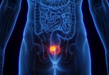 IMFINZI® de AstraZeneca reduce riesgo de recaída y mejora supervivencia en pacientes con cáncer de vejiga músculo invasivo