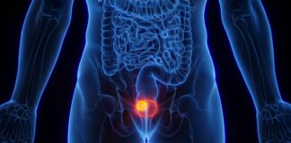 IMFINZI® de AstraZeneca reduce riesgo de recaída y mejora supervivencia en pacientes con cáncer de vejiga músculo invasivo